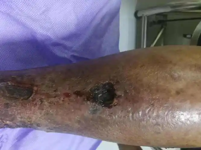 下肢皮肤坏死感染～慢创