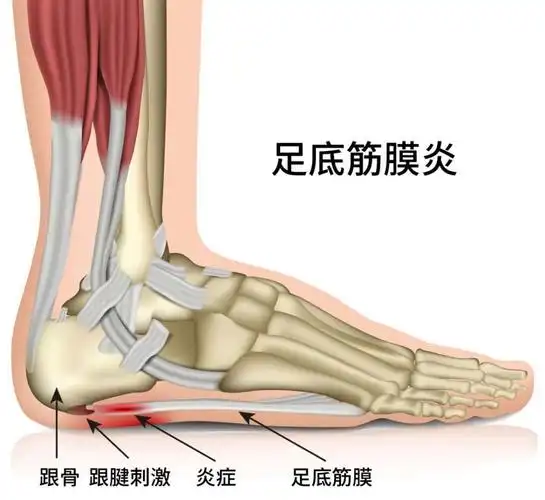 走路,站立时脚容易受力过大,可能会诱发韧带炎症及足底筋膜炎