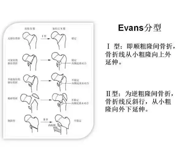 目前常用的分型有:ao/ota分型和改良evanss分型