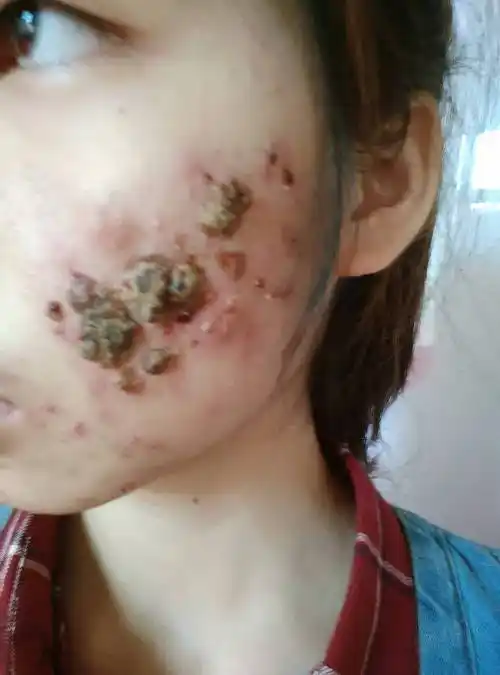 p>痤疮,俗称青春痘,粉刺,酒刺,暗疮,多发于青春期,好发于面颊,额部和