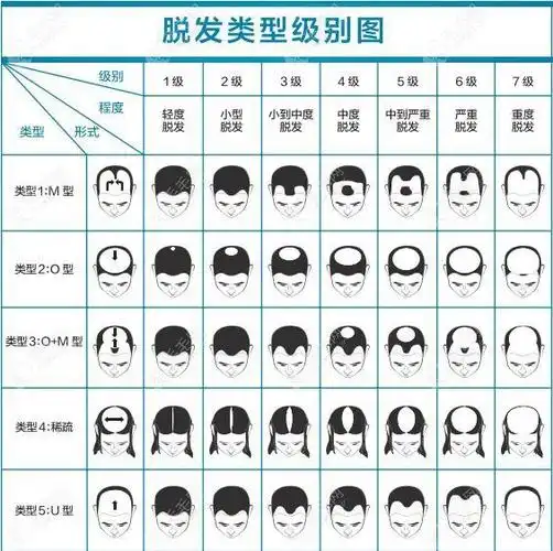 6级/7级脱发可能会植发5000毛囊单位
