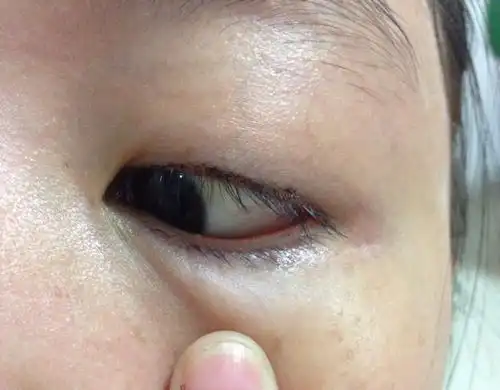 下眼睑边上长了一个透明的小疙瘩,不疼不痒有图,请问这是什么?