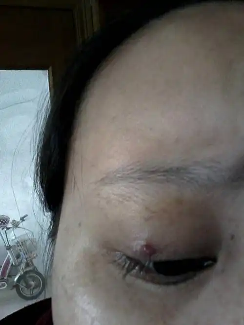 怀孕以后双眼皮上长了一个血泡,长了好几个月,不疼不痒,里面好像都是