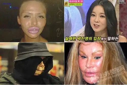 失败手术哪都有揭秘最易毁容的六种整容术