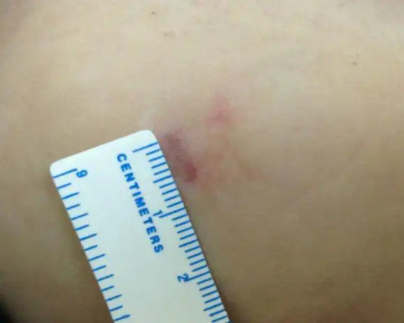 房间隔缺损个体化微创治疗_房间隔缺损_手术_治疗方式 - 好大夫在线