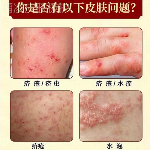 疥疮药膏喷节阴的囊结雾一扫光疥虫螨阴虱治疥硫专用苍磺软膏