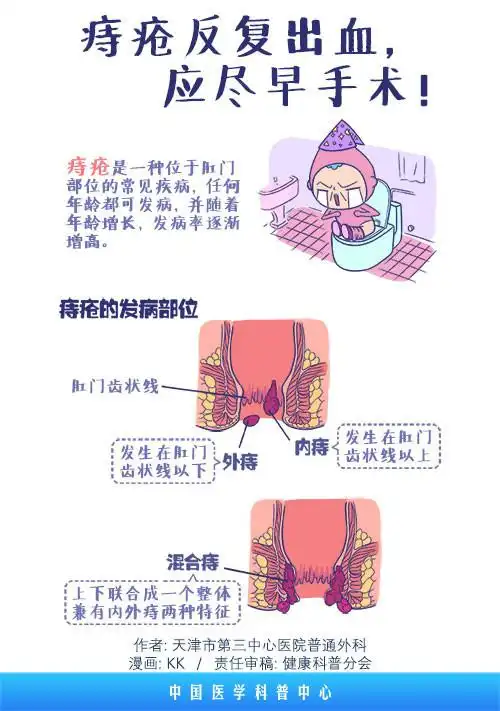 画说:痔疮反复出血,应尽早手术-天津市第三中心医院-政务网站发布