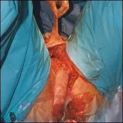 变性手术过程图示(男变女)