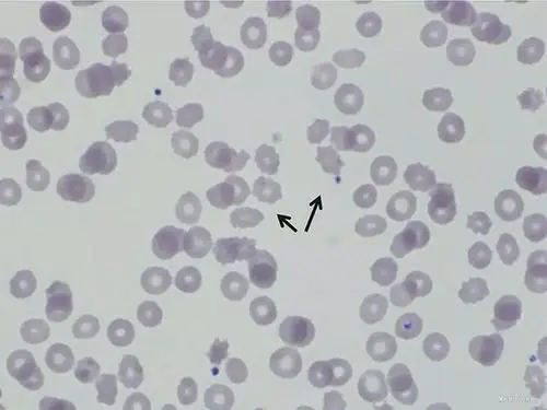 舞蹈病-棘红细胞增多症一例