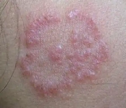 皮炎症状的图片