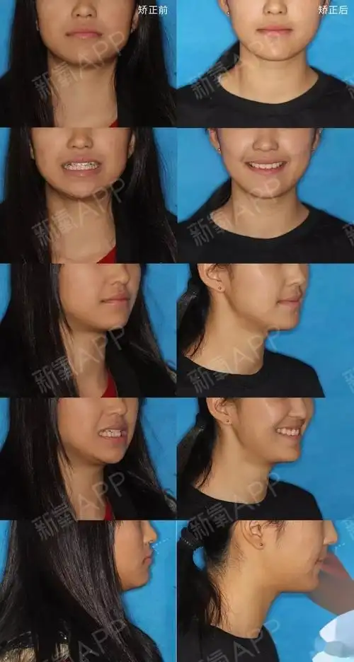 嘴突拥挤虎牙,23个月精致少女感达成!▌