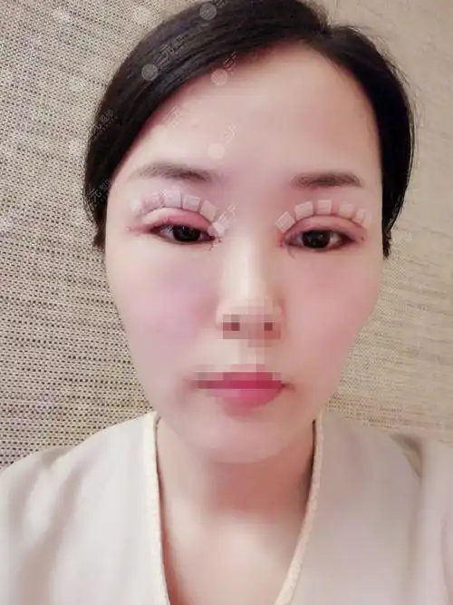 双眼埋线恢复一个月图记录,真是越看越喜欢,快来get同款吧