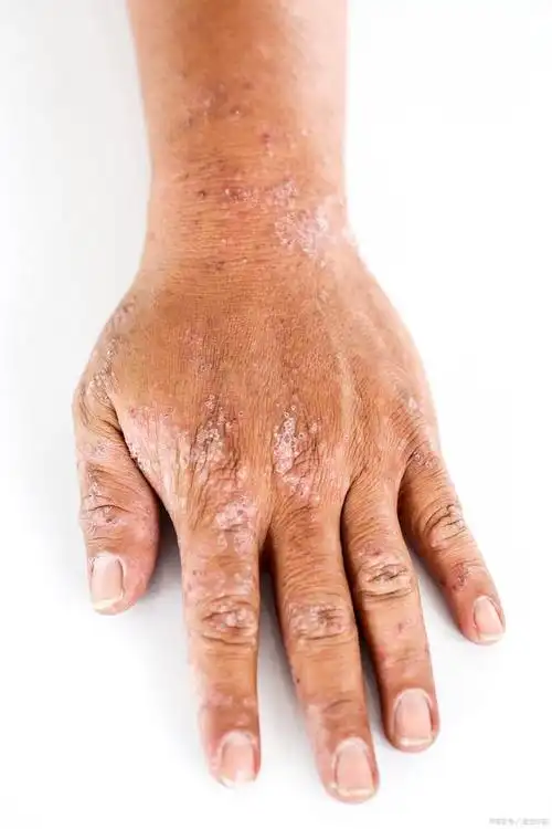 皮肤过敏是一种常见的皮肤病,其主要症状包括