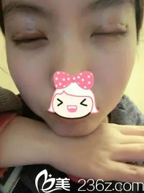 一美双眼皮手术后三天闭眼照