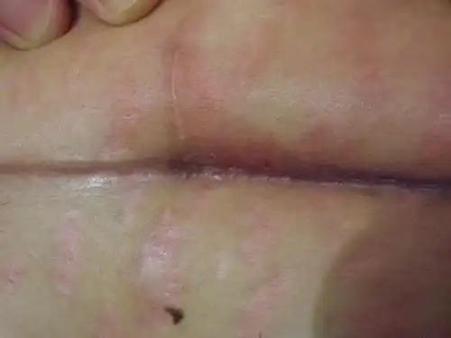 曾经脂肪液化合并感染现在出了小孔是线结反应吗