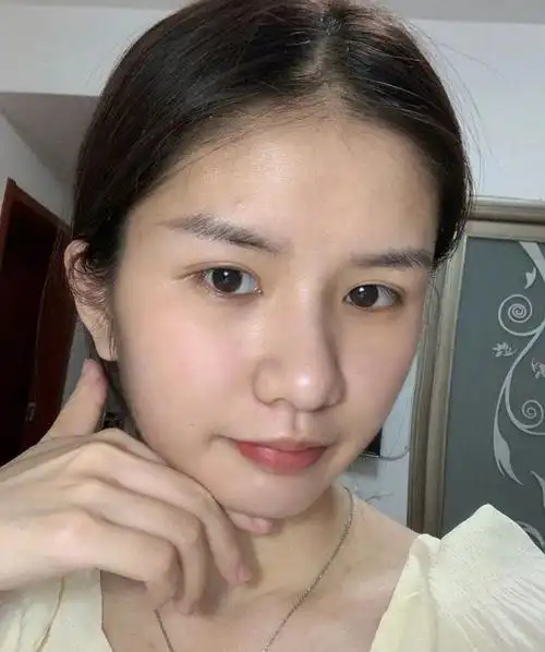 填充完后基本没什么恢复期,是即刻就能看出效果的~ 只不过前几天脸部