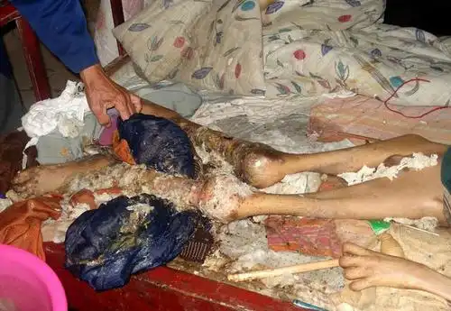 攀攀病情照片心理素质差者请勿看