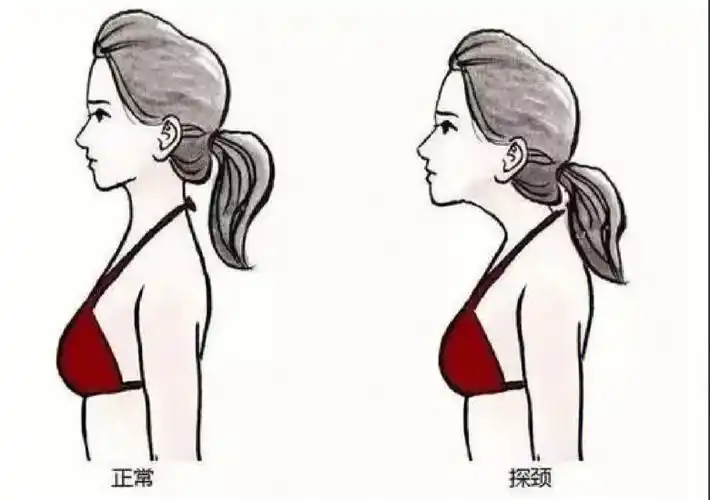 其实就是脖子前倾 脖子前倾称为颈椎前倾,正常情况下,颈椎曲线是向前