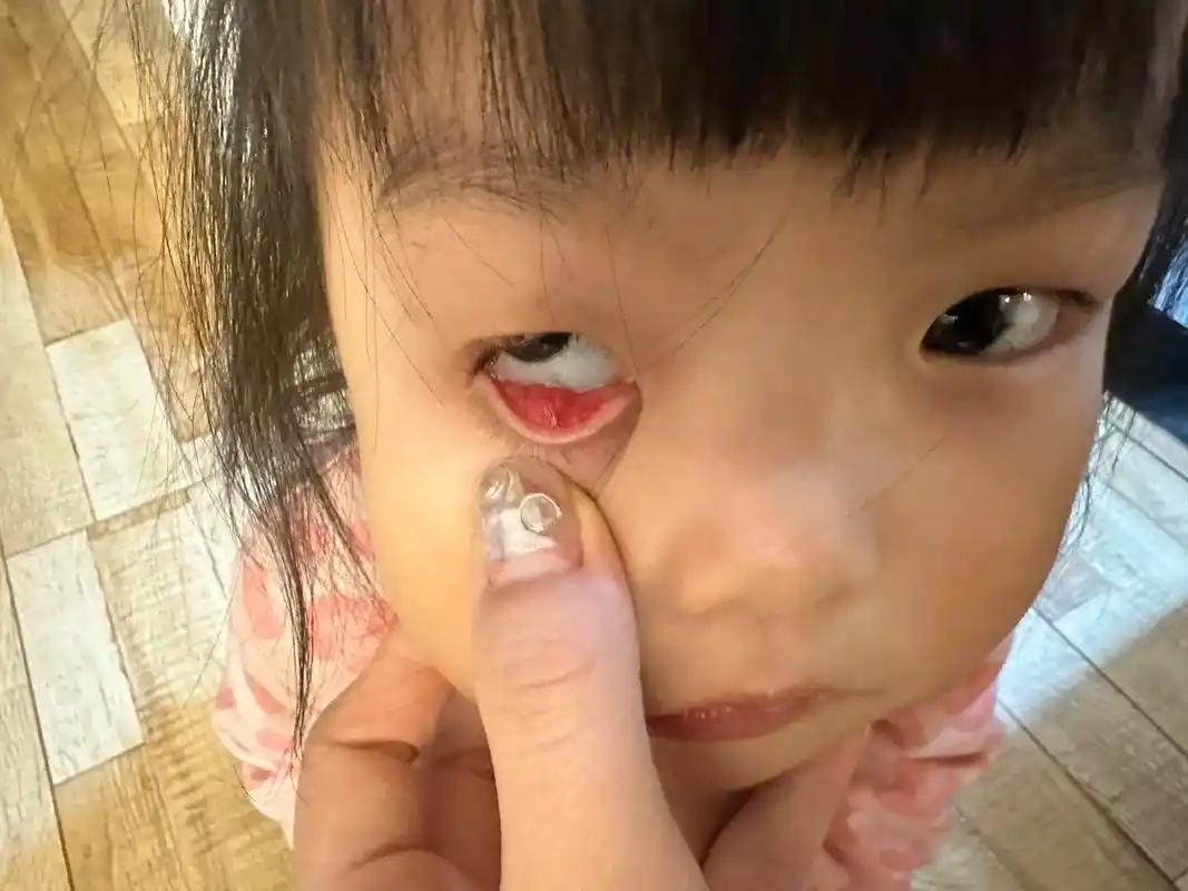 霰粒肿.#霰粒肿麦粒肿 #霰粒肿 霰粒肿一般不会自己消退 七 - 抖音