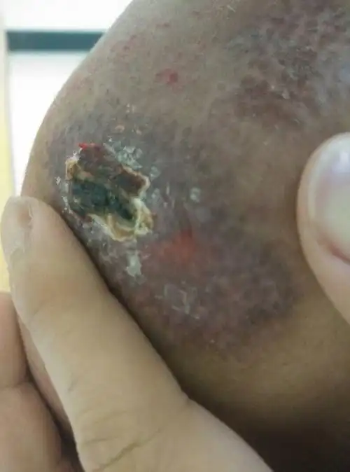 结痂感觉要掉 我就用手撕下来了,发现皮肤是红色的 而且有一点褶皱