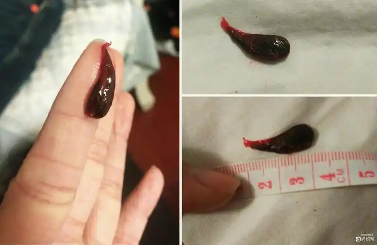 亲们 孕囊流出来了 终于不用受罪了 保佑 这段期间不要大出血就好了