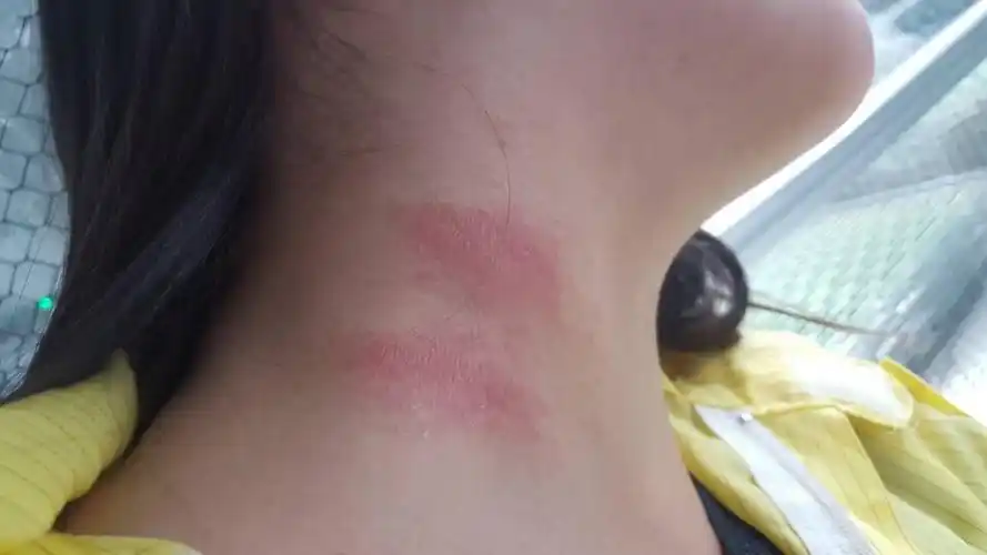 脖子里这样的皮肤已经有10天了.