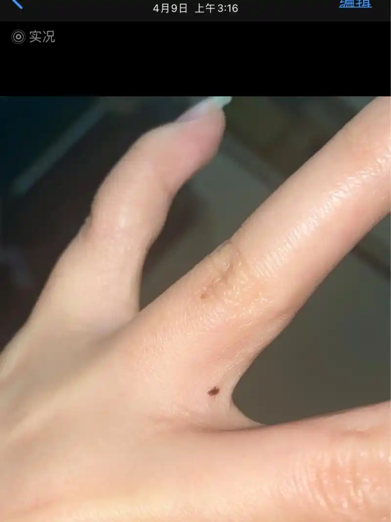 感觉手上的痣在慢慢变大 是错觉吗?