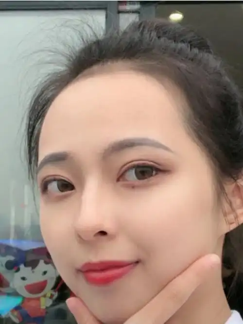 双眼皮完全自然要多久 双眼皮完全自然要多久才能恢复