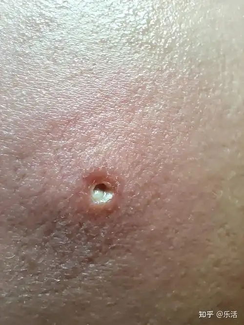5岁的孩子长了个疥疮引以为戒