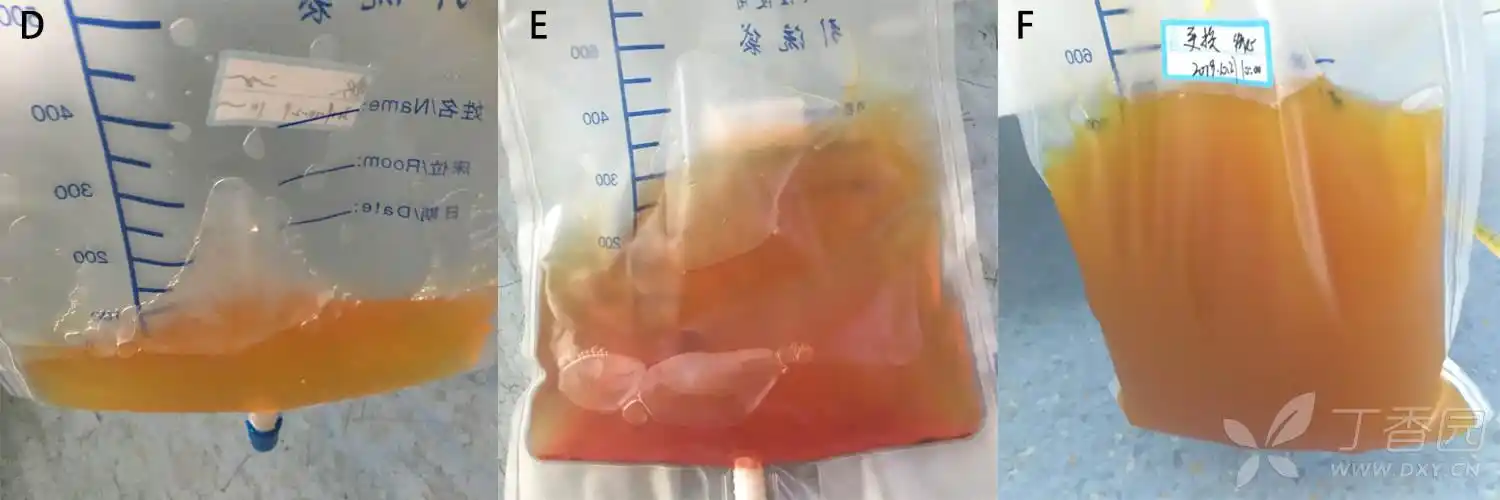 g:出血;h:乳糜瘘;i:胆瘘