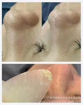 美容院毛囊清洁术产品oem加工 清洁毛孔  净肤霜去黑头粉刺按摩