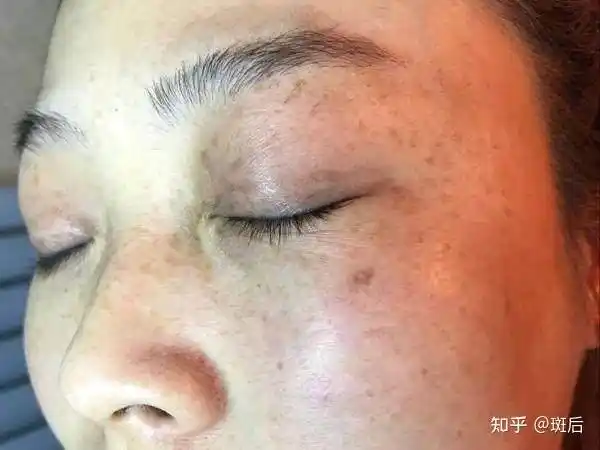 斑后女人容易长斑要想皮肤变年轻的小窍门