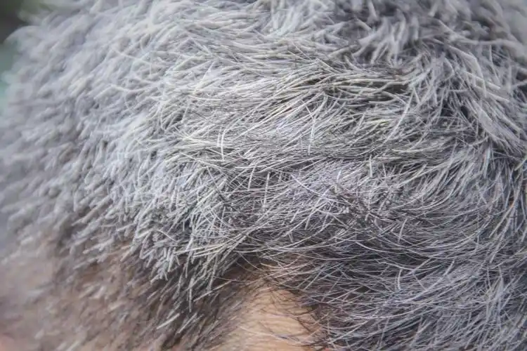 拔掉一根白头发,会长 10 根?到底要不要拔?答案是