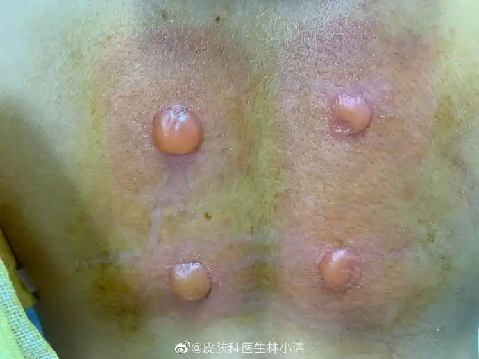 皮肤科医生林小清这位小姐姐去做三伏炙后出现局部烧伤,水疱等因为