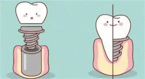 种植牙卡通图