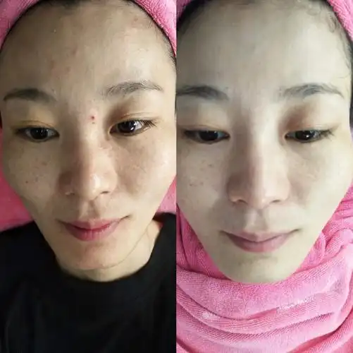 天然百草药膜调理前后对比图