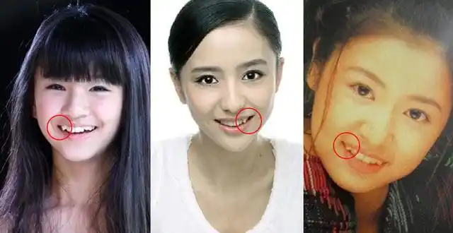 "虎牙"未必要拔,虎牙可以牙齿矫正吗?