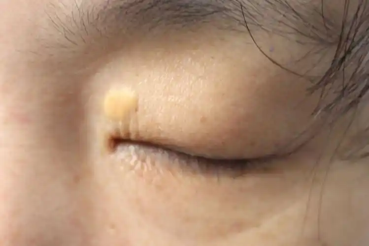 眼皮脂肪瘤