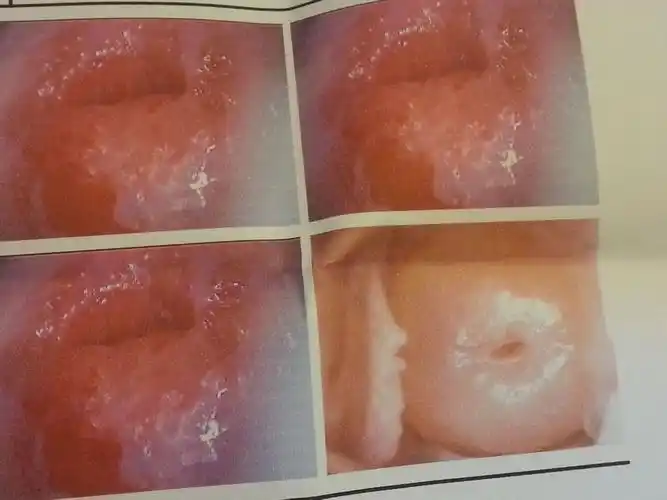 去医院检查说我有宫颈糜烂 盆腔积液和阴道炎,让我做手术 想请问有