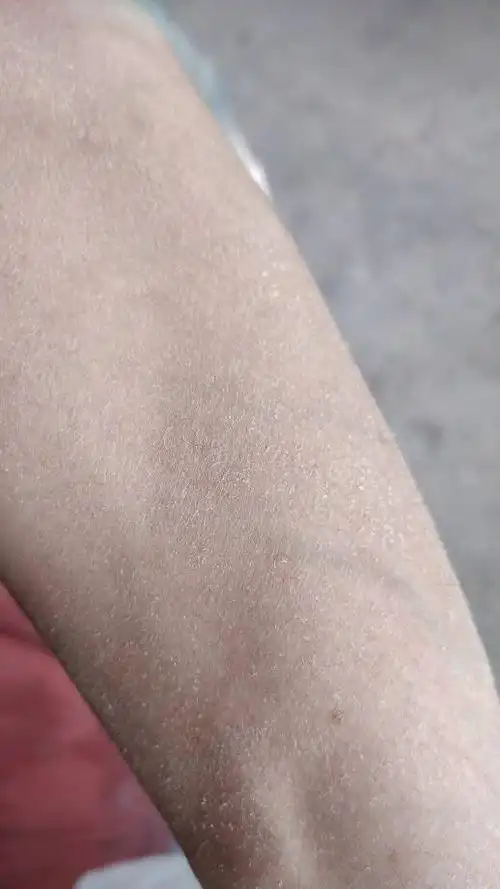 啊  37 分钟前   最佳答案 我建议你到医院查一下,我感觉有点像皮肤病