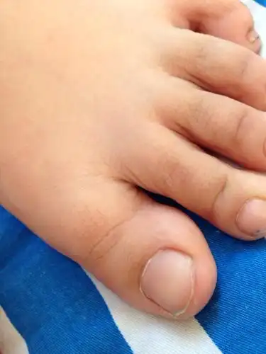 宝贝大脚趾和别的不同!这种情况正常吗?