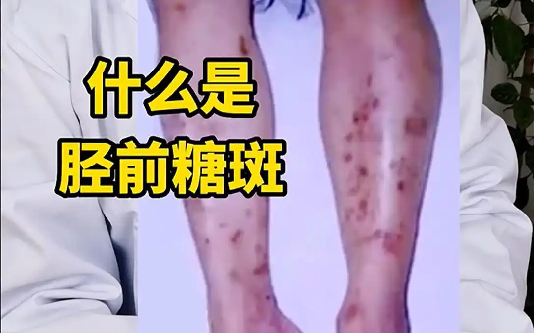 小腿上出现这种斑,预示糖尿病并发症出现吗?千万要提高警惕!