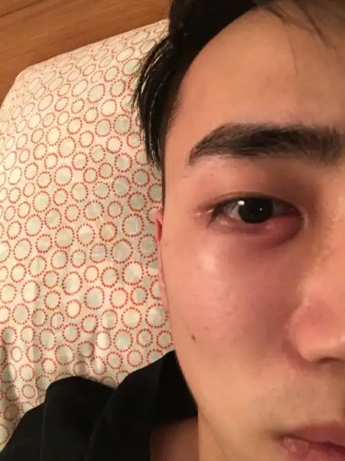 请问我这个是怎么了 突然本来整个下眼袋很肿 然后滴眼药水消炎的 旁