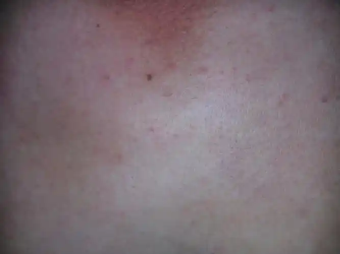 胸部有这样一粒粒的怎么了?