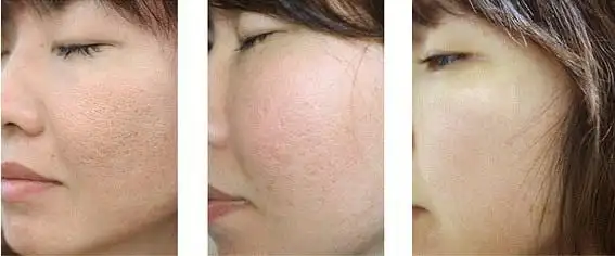 工作有时候挺忙的,这时候皮肤更有不好的趋势,毛孔粗大从原来的t部