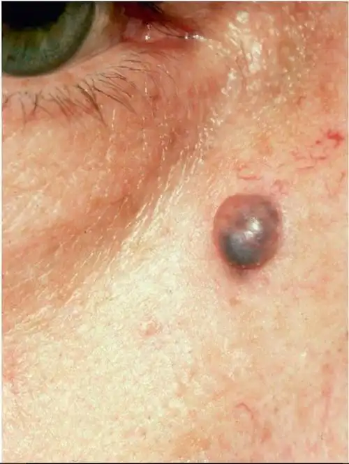 大汗腺汗囊瘤临床表现▲大汗腺汗囊瘤:多房性囊肿▲小汗腺汗囊瘤