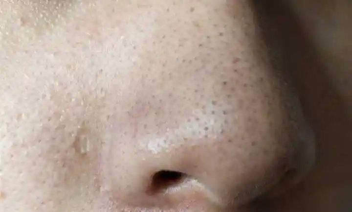 鼻子上的这种黑头(粉刺)的治疗