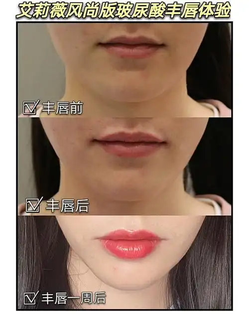 玻尿酸丰唇体验,艾莉薇嘟嘟唇注射效果repo来咯