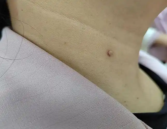 脖子上长小肉疙瘩,别不当回事,或是这些疾病的征兆!