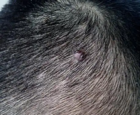 网上查了说是头皮疣,这是什么?不治疗可以吗.